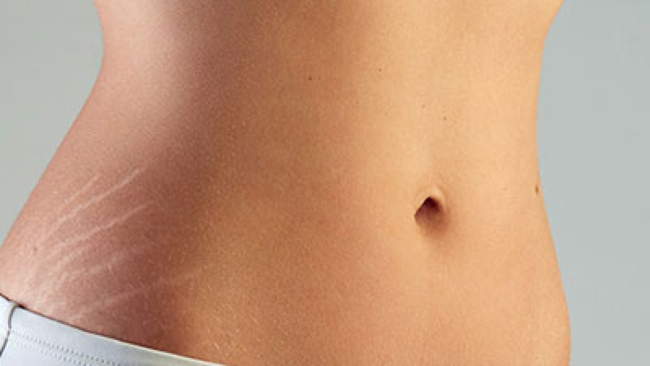 What Stretch Mark Treatments Are The Most Effective?